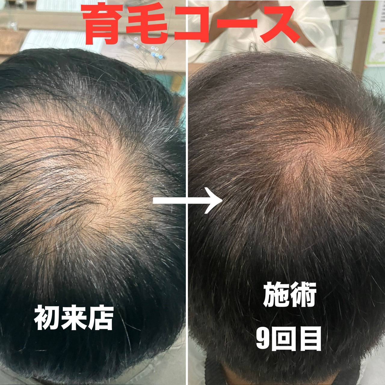 育毛コース